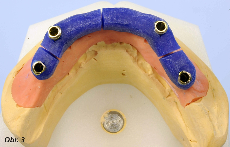 Přes hlavní model se po umístění čtyř kovových přenosových krytek vyrobí pryskyřičná šablona a jakmile se vytvrdí, obrousí se a rozdělí, aby se odstranily následky smrštění nebo jiné nepřesnosti vzniklé vlivem polymerace – šablona se dodá do zubní ordinac