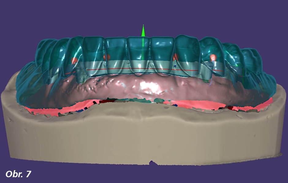 Po vytvoření průhledné výstavby zubů se začne s navrhováním základní konstrukce třmenu zohledňujícím dostupný prostor a pozice zubů a implantátů. Vyhodnotí se rovněž žvýkací rovina ve vztahu k hlavní rovině navrhované základní konstrukce.