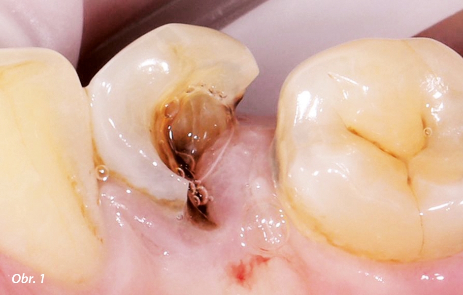 Výchozí situace: zub 34 byl vážně poškozen a gingivální tkáň přerostla do defektu.