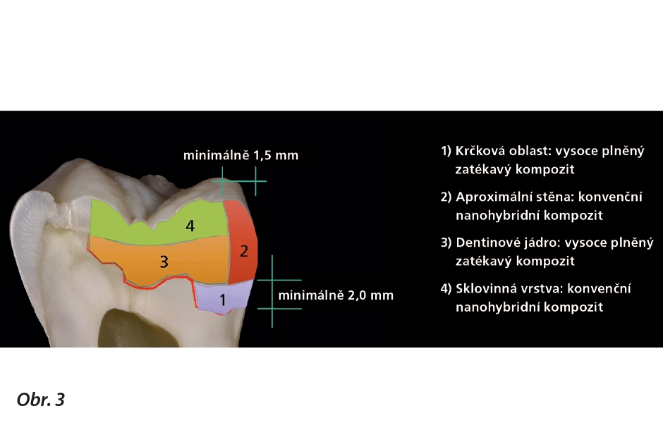 Průřez rekonstrukcí II. třídy. Tetric EvoFlow Bulk Fill lze aplikovat v jedné vrstvě (viz vrstva 1 a 3), aplikovaná vrstva materiálu však nesmí přesáhnout tloušťku 4 mm