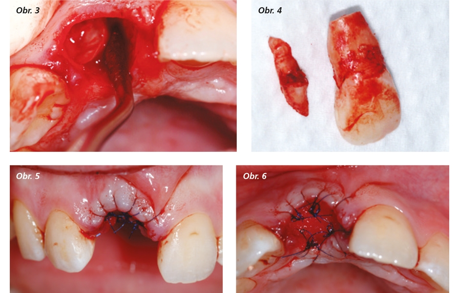 Pečlivá extrakce zlomeného prvku zubu – všimněte si použití periotomu a lůžko augmentované xenoštěpem a uzavřené přišitou membránou