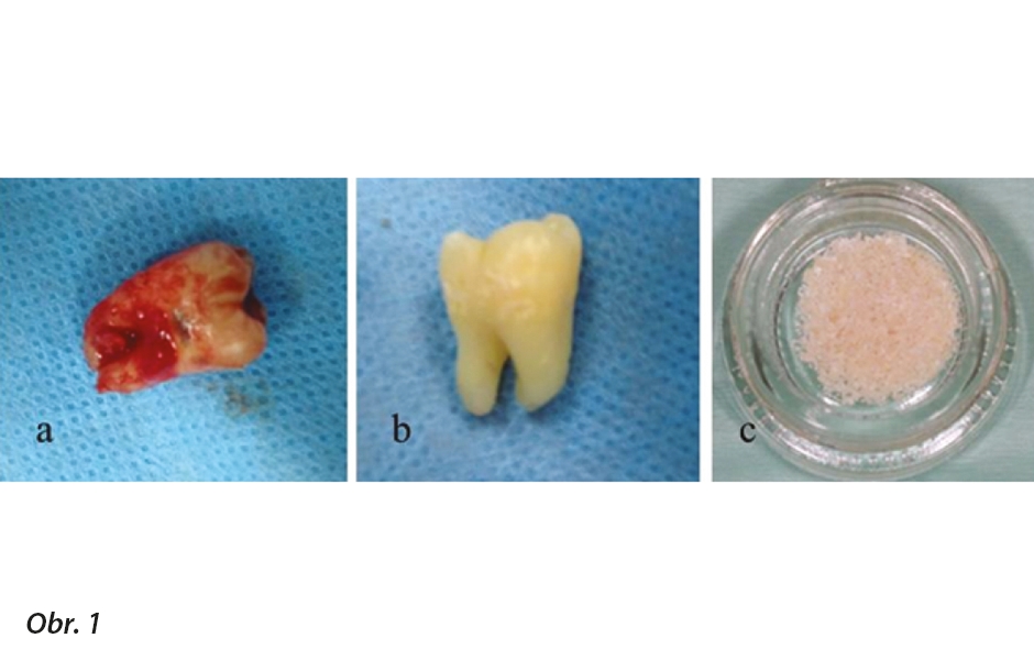 Zpracování extrahovaného zubu na imediátní štěp z autogenního dentinu