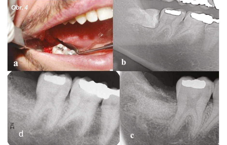 Zpracování extrahovaného zubu na imediátní štěp z autogenního dentinu