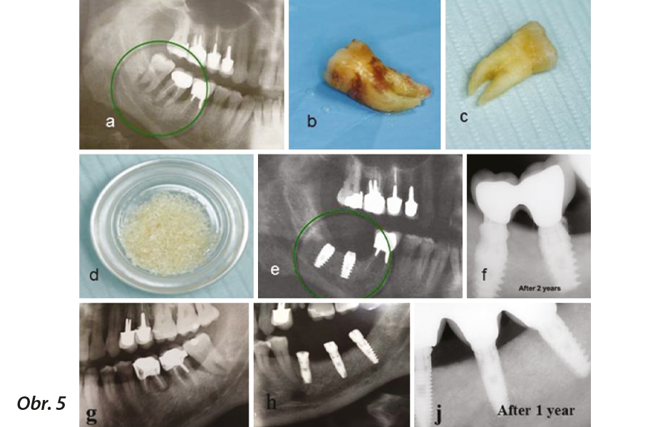 Zpracování extrahovaného zubu na imediátní štěp z autogenního dentinu