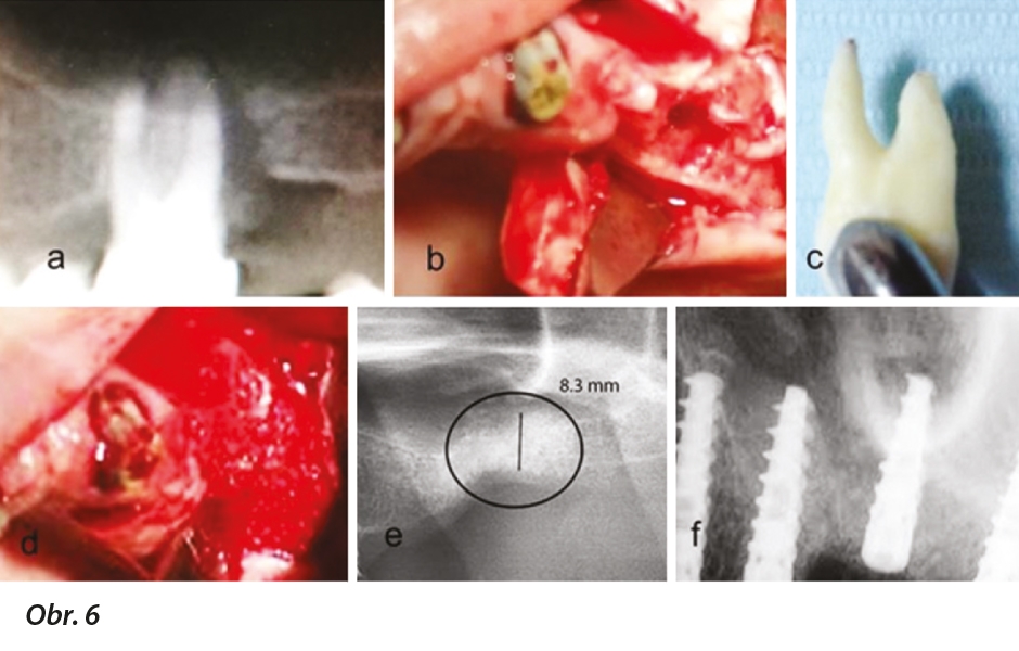Zpracování extrahovaného zubu na imediátní štěp z autogenního dentinu