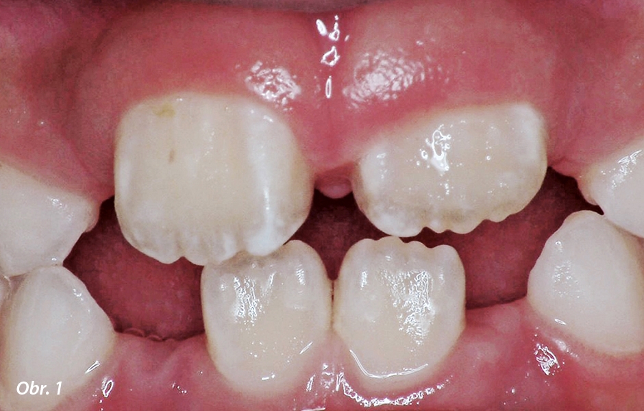 Vzhled při příchodu: plakem obalené nově prořezané stálé zuby