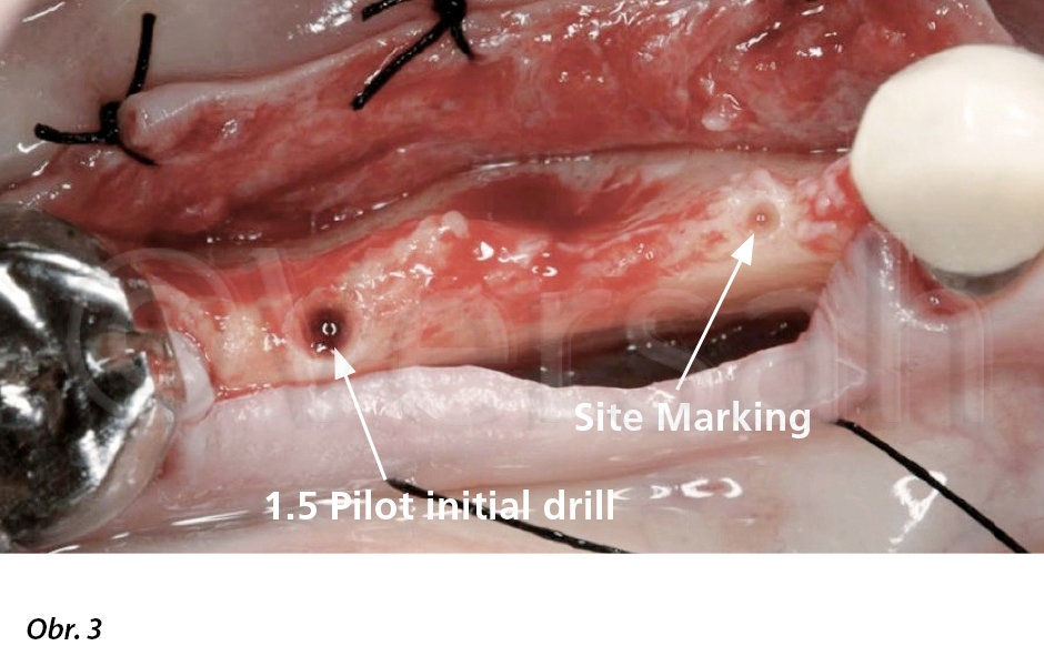 Osteotomie o rozměrech 1,5/13 mm byla provedena s použitím standardního pilotního vrtáku o průměru 1,5 mm