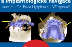 Digitální plánování a implantologické navigace