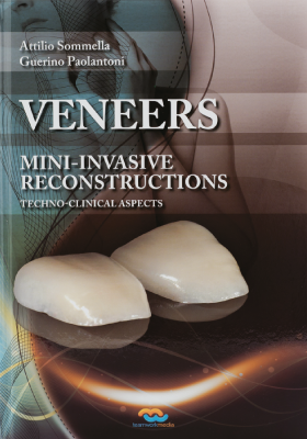 Veneers – Mini-invasive Reconstructions